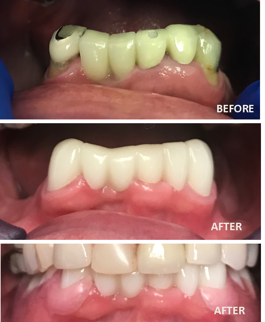Front Tooth Crown